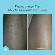 Perfect Image Gly 10% + Sal 2% Exfoliating Body Lotion Enhanced with Green Tea Papaya Bearberry Licorice Amino Complex