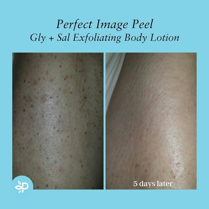 Perfect Image Gly 10% + Sal 2% Exfoliating Body Lotion Enhanced with Green Tea Papaya Bearberry Licorice Amino Complex