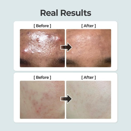 Numbuzin No.1 Pure Full Calming Herb Toner for Acne-Prone Skin with Centella Asiatica