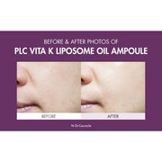 PLC Vitamin K Liposome Oil Ampoule Special Care for Toning, Glowing, Hydration, Brightening Skin-Friendly Water & Oil Layer Formula Serum for Dark Area Dr.Ceuracle